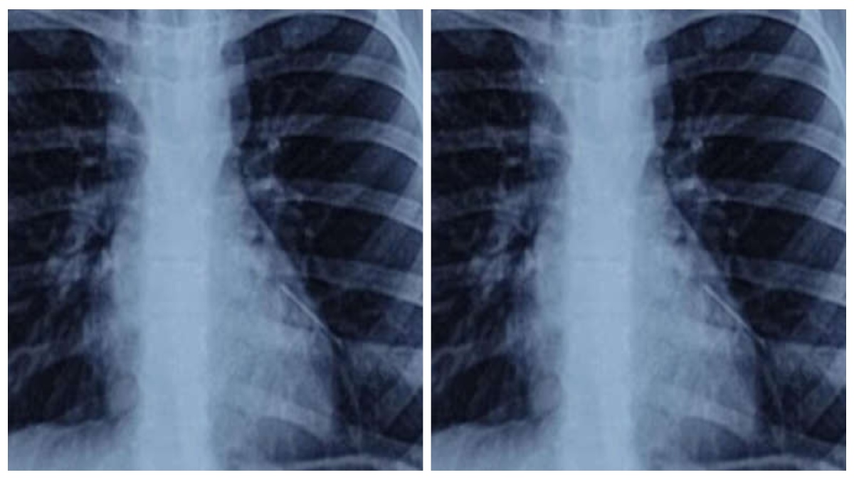 METALLIC PIN REMOVED SUCCESSFULLY FROM CHILD’S LUNG