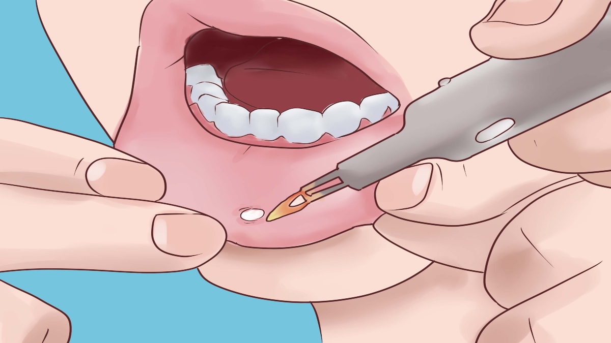 UNRESPONSIVE MOUTH ULCER CAN BE CANCER