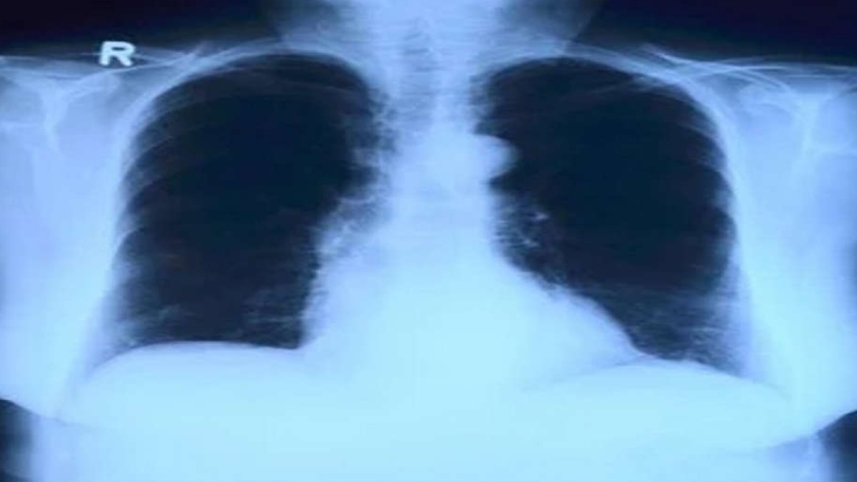 AI TOOL USES CHEST X-RAY TO DIFFERENTIATE WORST COVID CASES