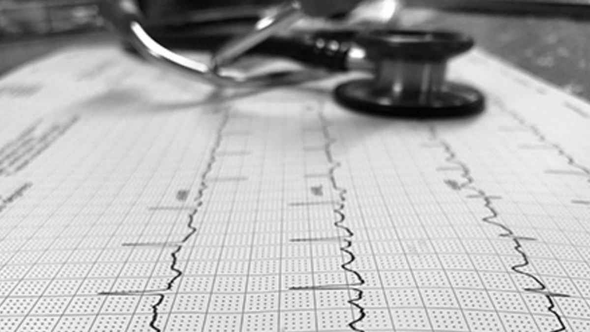 WHY YOUNGER ATHLETES AT GREATER RISK OF ATRIAL FIBRILLATION THAN OLDER ONES