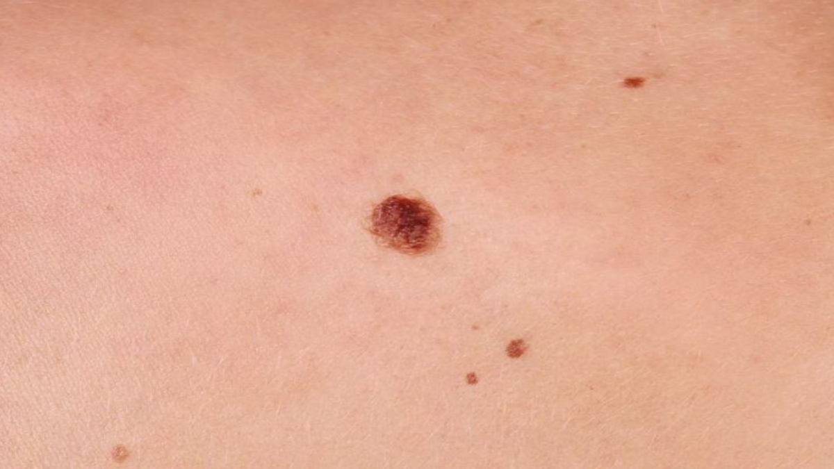 STUDY FINDS WHY MOLES BECOME MELANOMAS