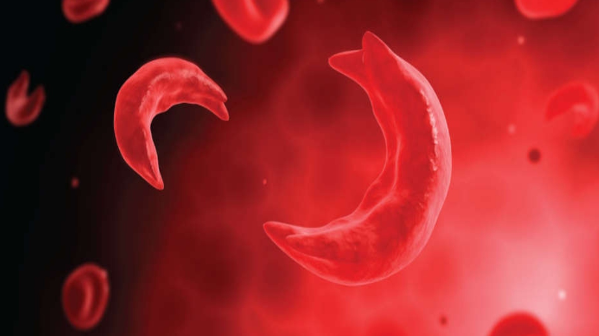 EXPERIMENTAL GENE THERAPY REVERSES SICKLE CELL DISEASE FOR YEARS