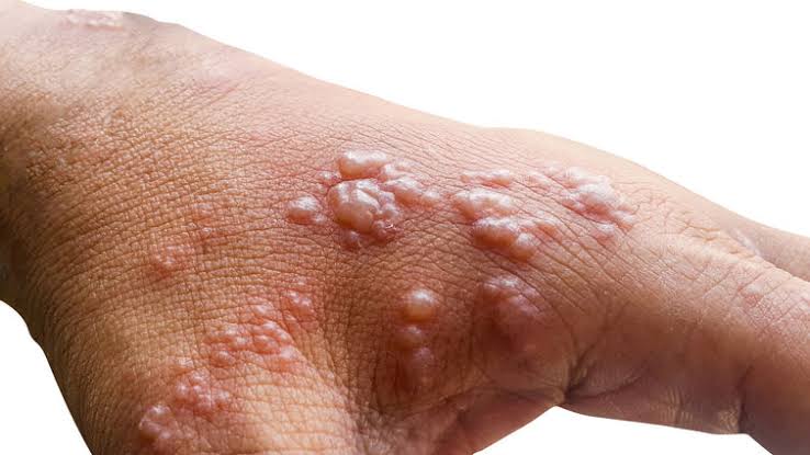 Third case of Monkeypox reported in Kerela