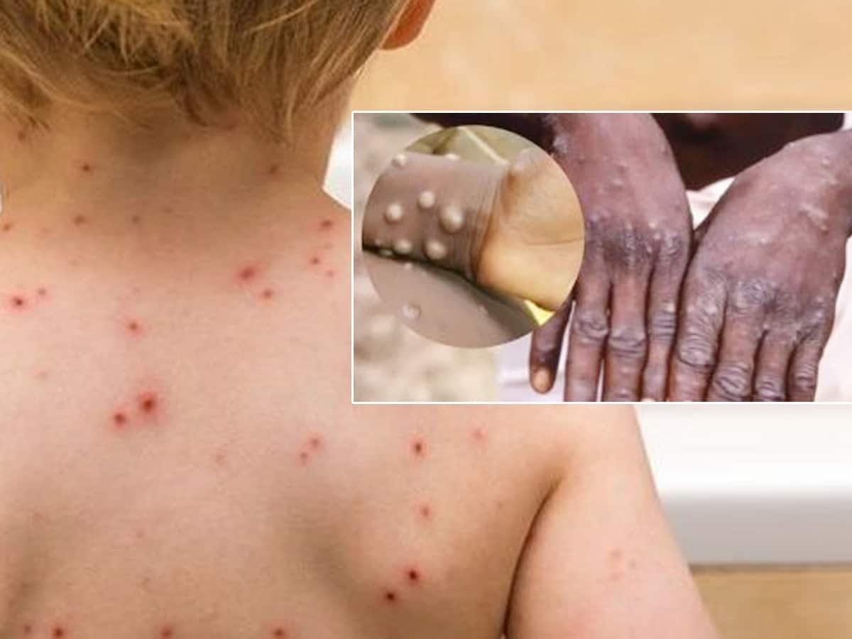 Vietnam reports its first case of monkeypox