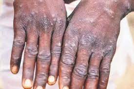 Another case of Monkeypox in Kerela, tally rose to 5