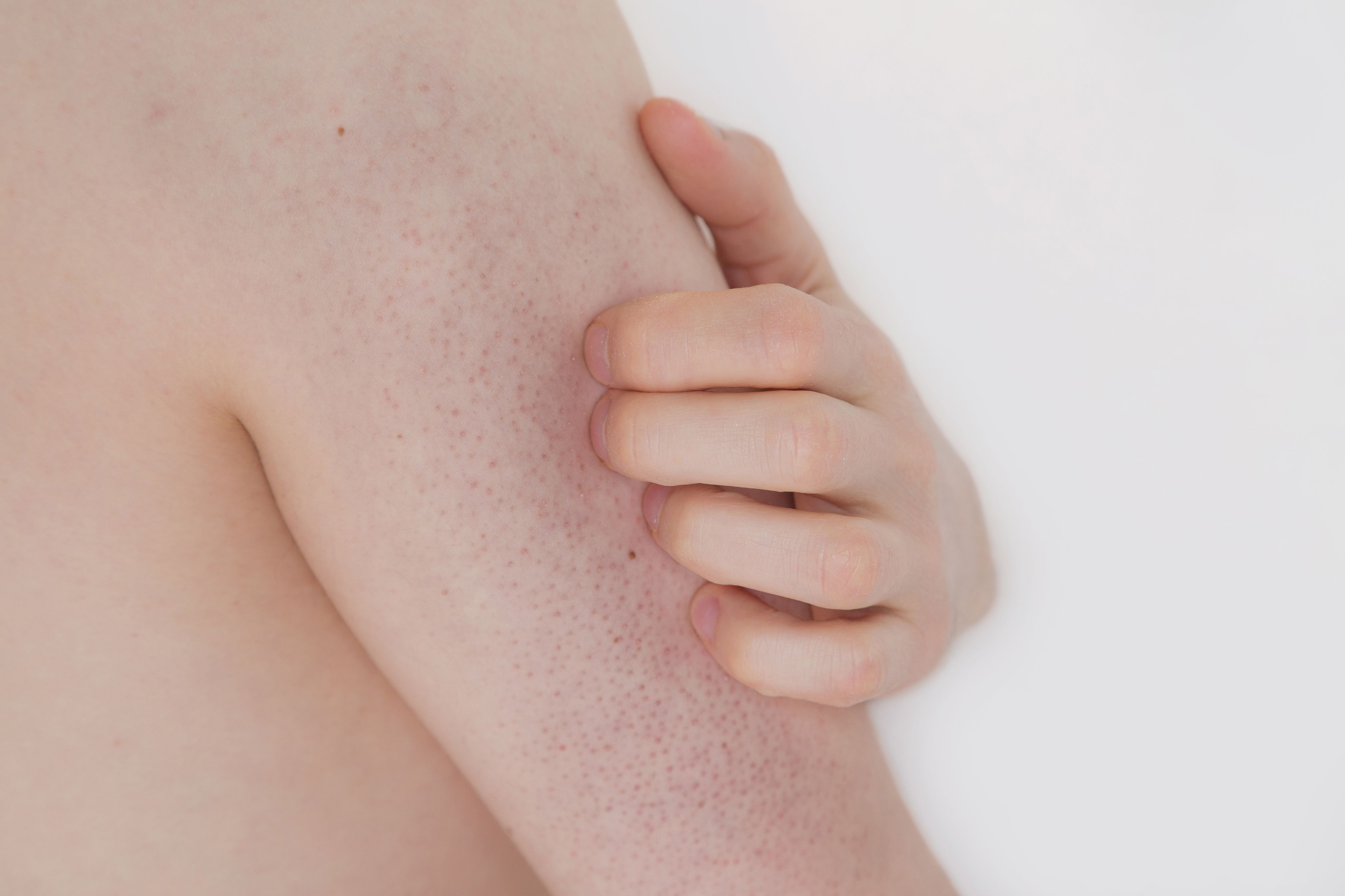 Have you got chicken skin? It’s actually Keratosis Pilaris