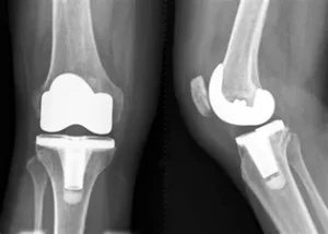 Rising trend of joint replacement surgeries in young adults in their 30s and 40s