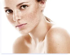 The secret to Indian beauty: Managing Hyperpigmentation through diet