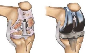 Metal Allergies and Sensitivities in Knee Replacement