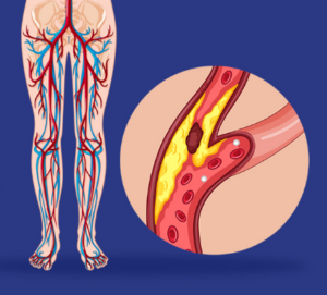 Peripheral Artery Disease: No need of Amputation if checked in time