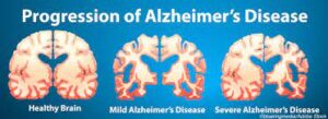 Alzheimer’s Disease: How to delay early onset of Alzheimer’s Disease