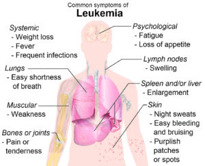 Childhood Leukaemia: Understanding the Causes, Prevalence and Treatment of the Disease