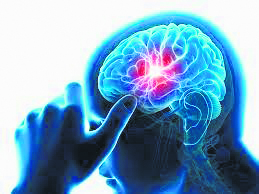 Is Stress the Sole Culprit Behind Stroke? Debunking