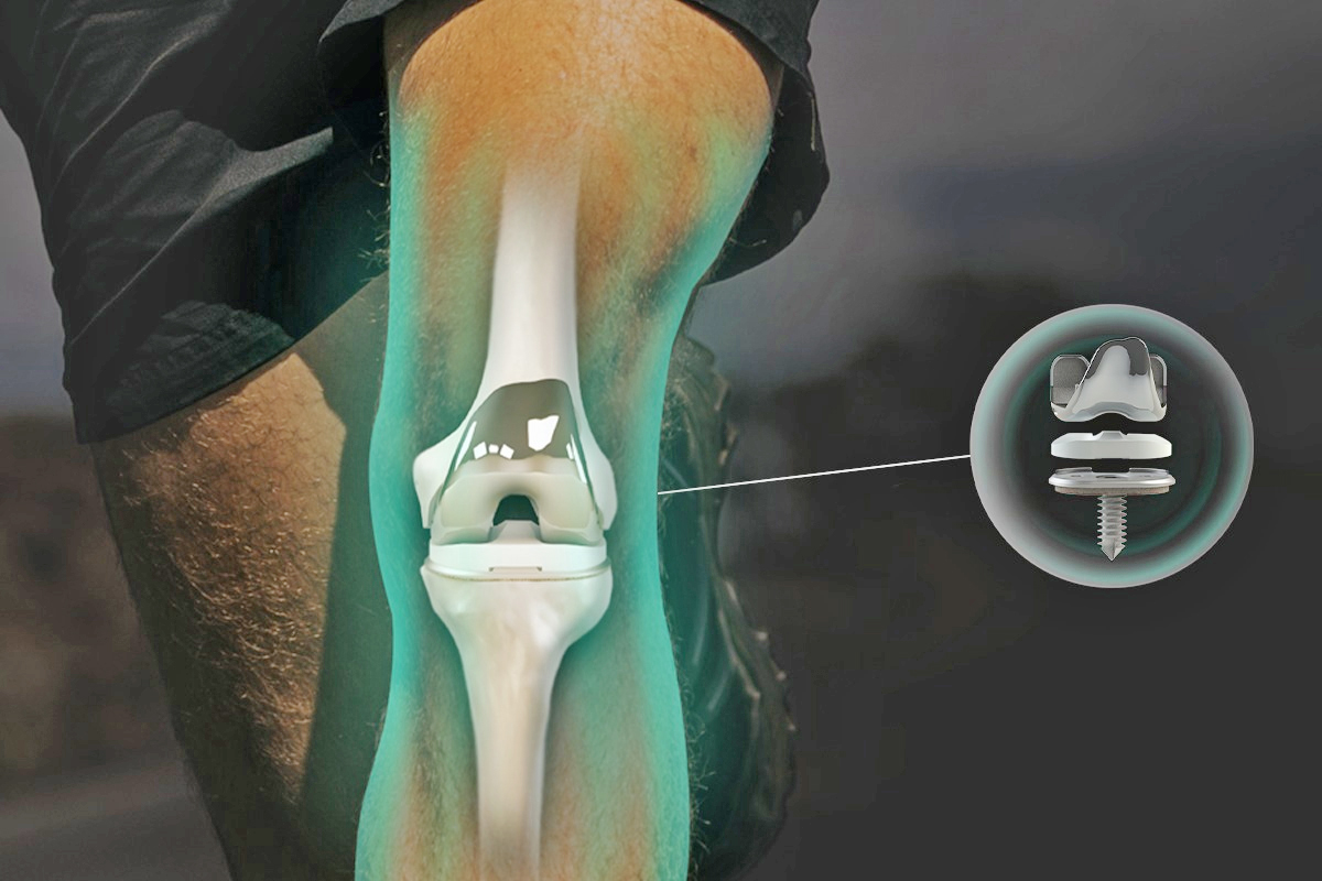 Revolutionizing knee replacement: precision through 3D printing