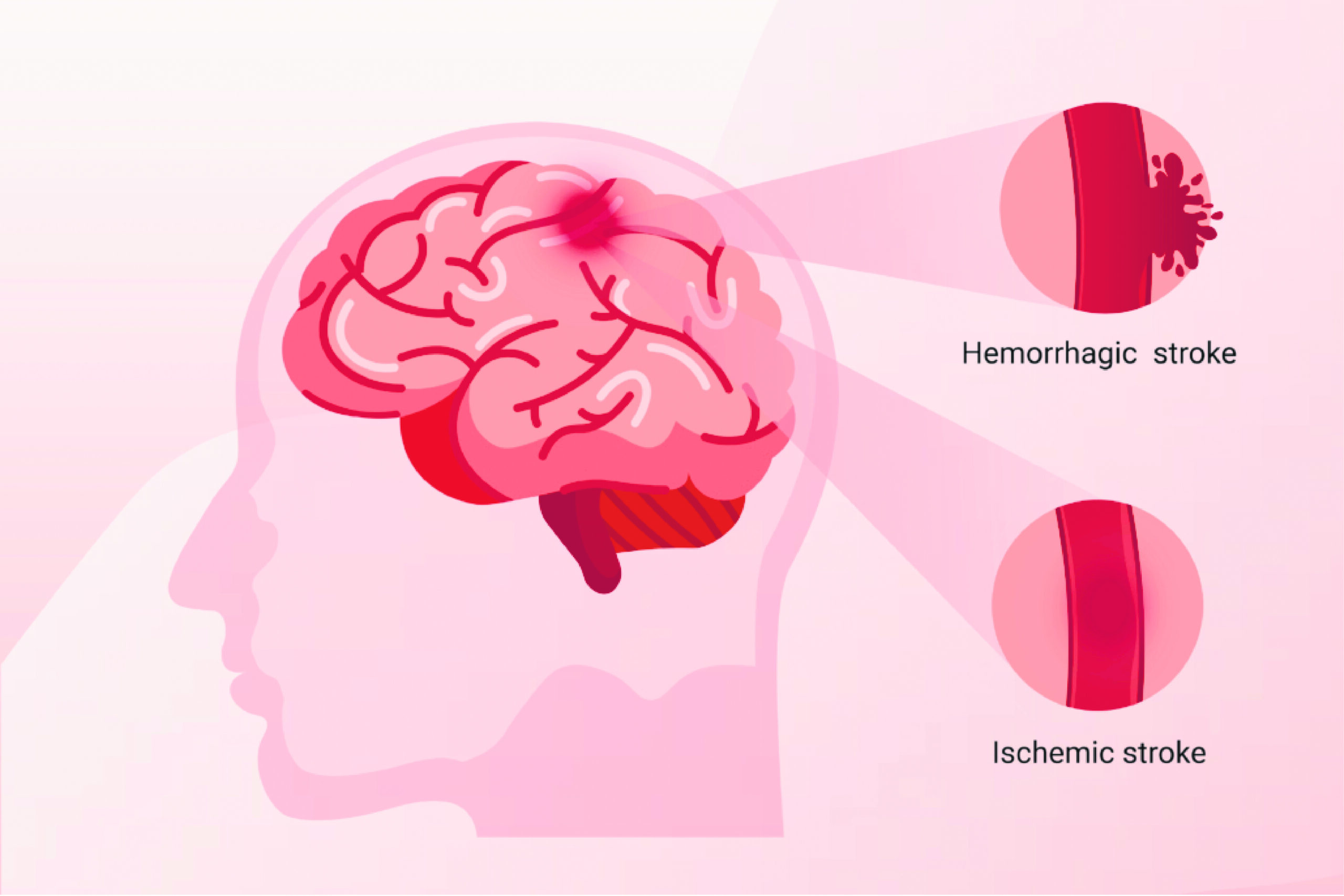 Winter Worries: Hypertension and the Elevated Risk of Stroke