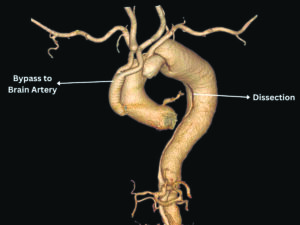 Life-saving Hybrid procedure at SSB heart hospital