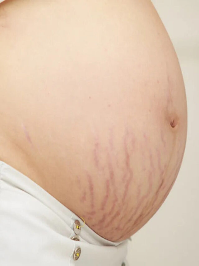 Essential Oils to Prevent Stretch Marks During Pregnancy