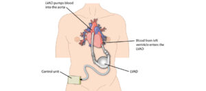 Suffering from heart failure? Could LVAD therapy be right for you? Know everything from a cardiologist