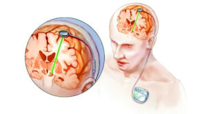 How deep brain stimulation surgery has been improving the lives of patients with Parkinson’s