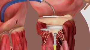 Transcatheter Mitral Valve Replacement in MAC with Electrowire surgery successfully performed with Sapien 3 valve