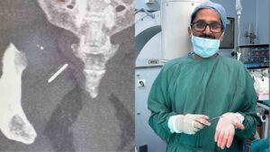 Needle Extracted That Travelled In Veins Of A Woman For Three Years