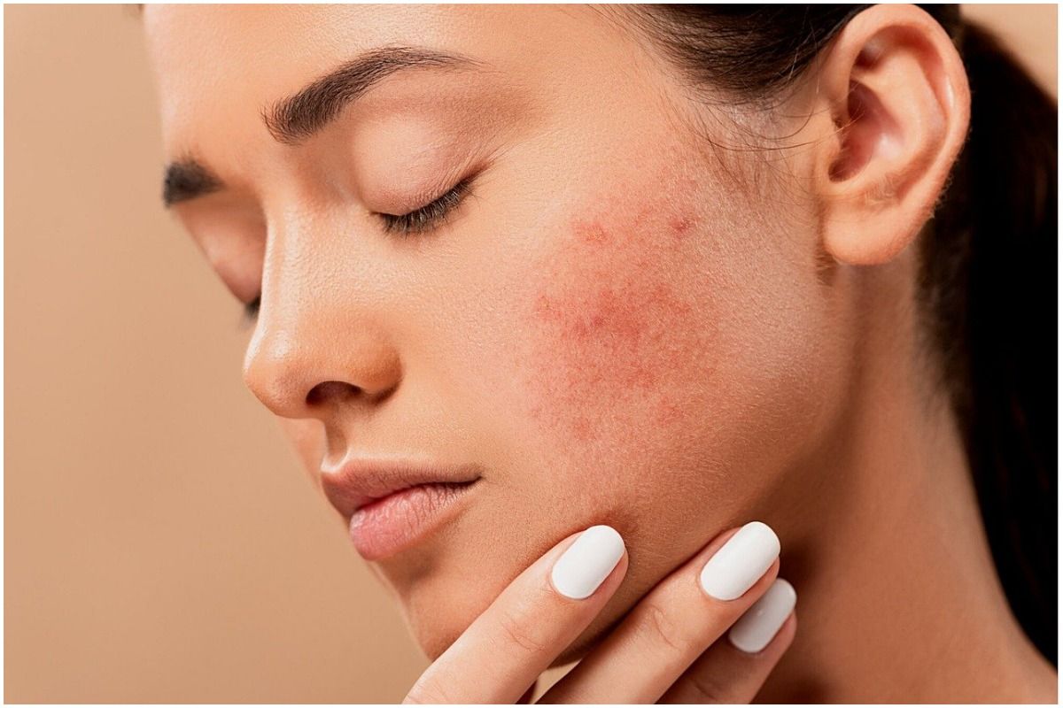 Skincare Mistakes To Avoid In Monsoon