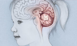 Pediatric Brain Tumors: Complex Challenges and Evolving Treatments