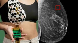 AI Model Predicts Breast Cancer Risk Years Ahead: Anand Mahindra’s Tweet Goes Viral