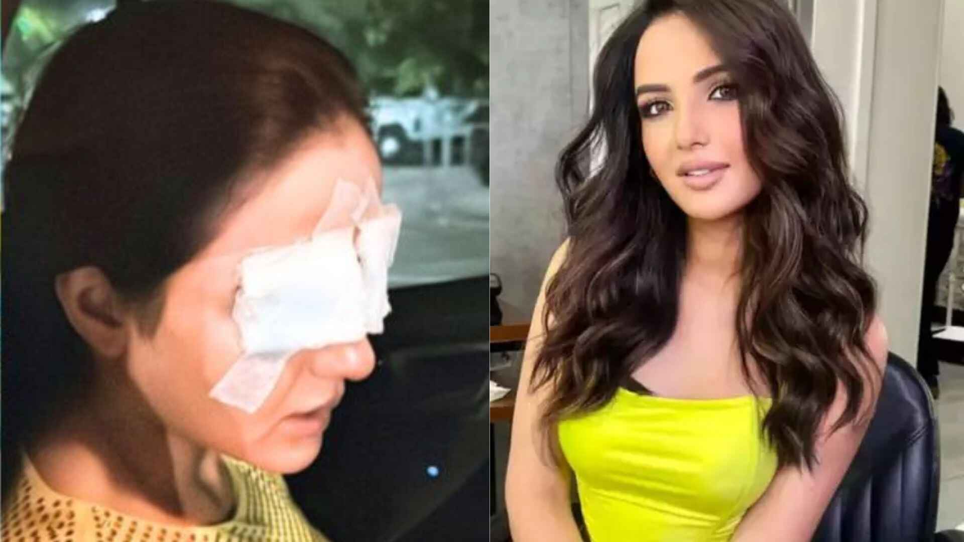 Jasmine Bhasin’s Eye Injury: Contact Lens Problem Causes Corneal Damage