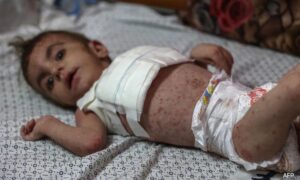 New Skin Diseases Ravage Gaza’s Children Amidst War