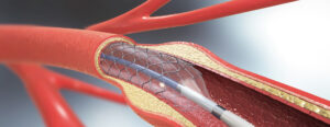 Case Study:  20-YEAR-OLD STENTS, TREATED AGAIN WITH ROTA-ANGIOPLASTY