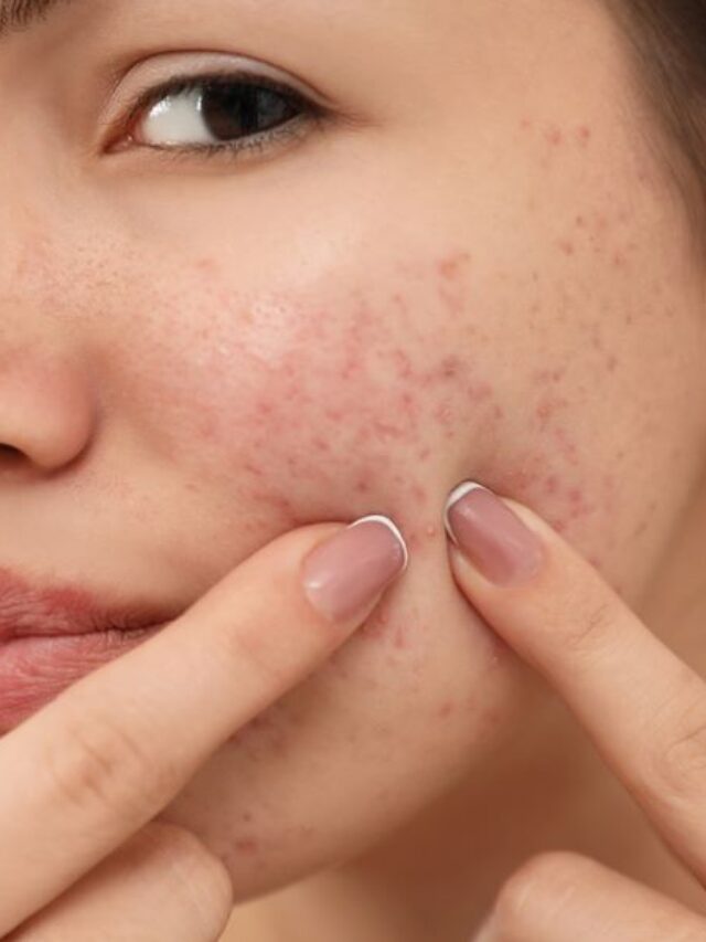 Say Goodbye to Acne Scars: Discover the Secret to Smooth, Clear Skin!