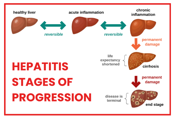 Addressing Common Myths and Misconceptions about Hepatitis