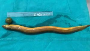 Indian Man Inserts 2-Foot Live Eel Into Anus, Chewed Through His Intestines