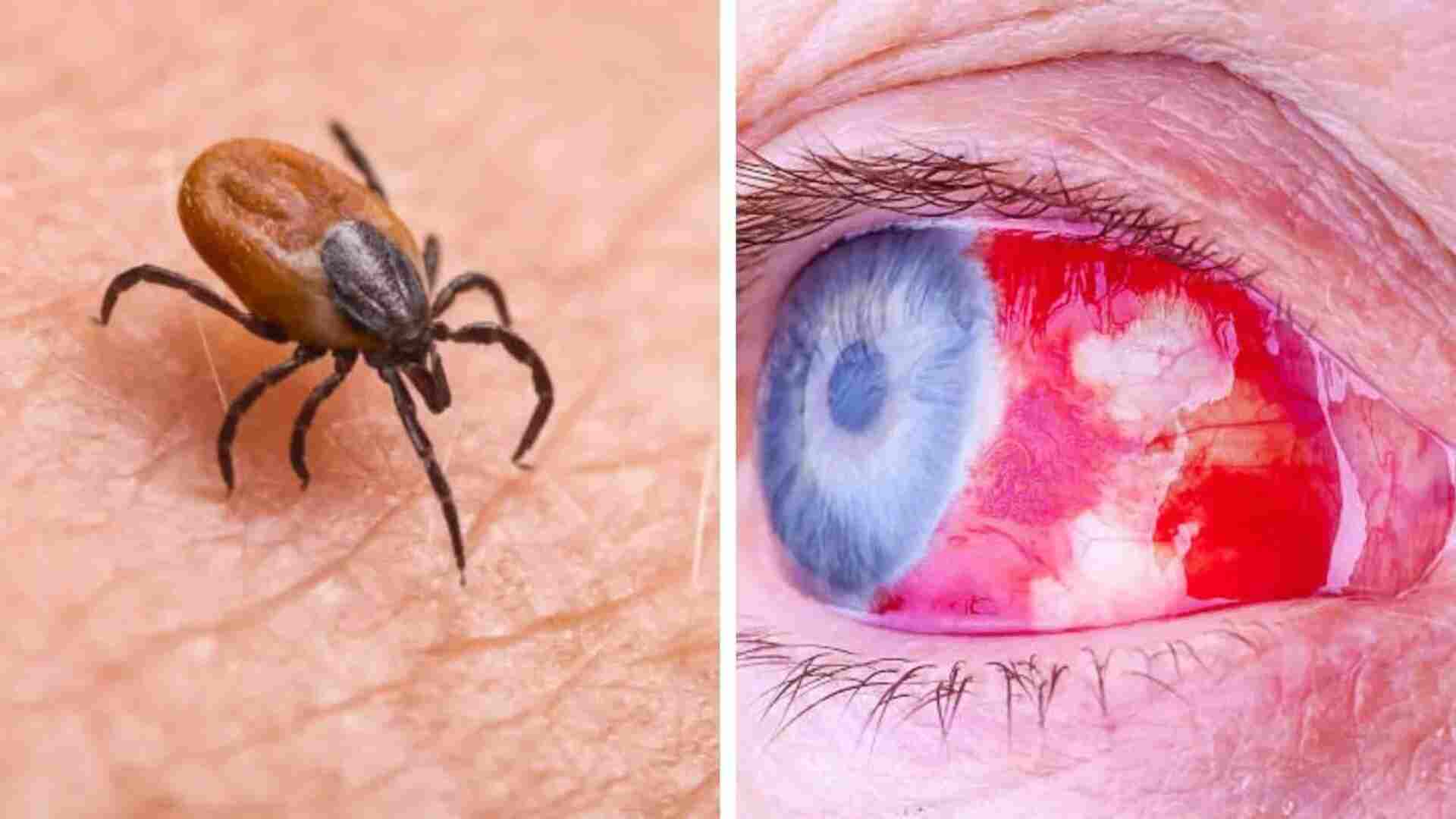 Teen Contracts Deadly Eye-Bleeding Virus: Crimean-Congo Hemorrhagic Fever | Explained