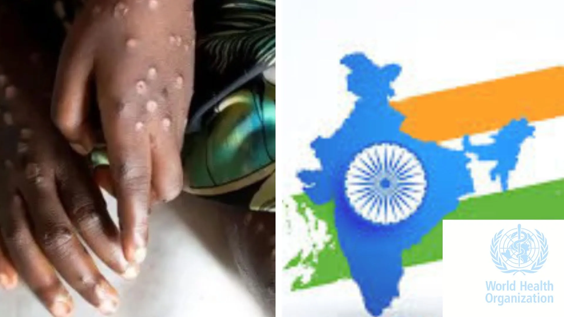 India remains vigilant as WHO declares Mpox a global health emergency;