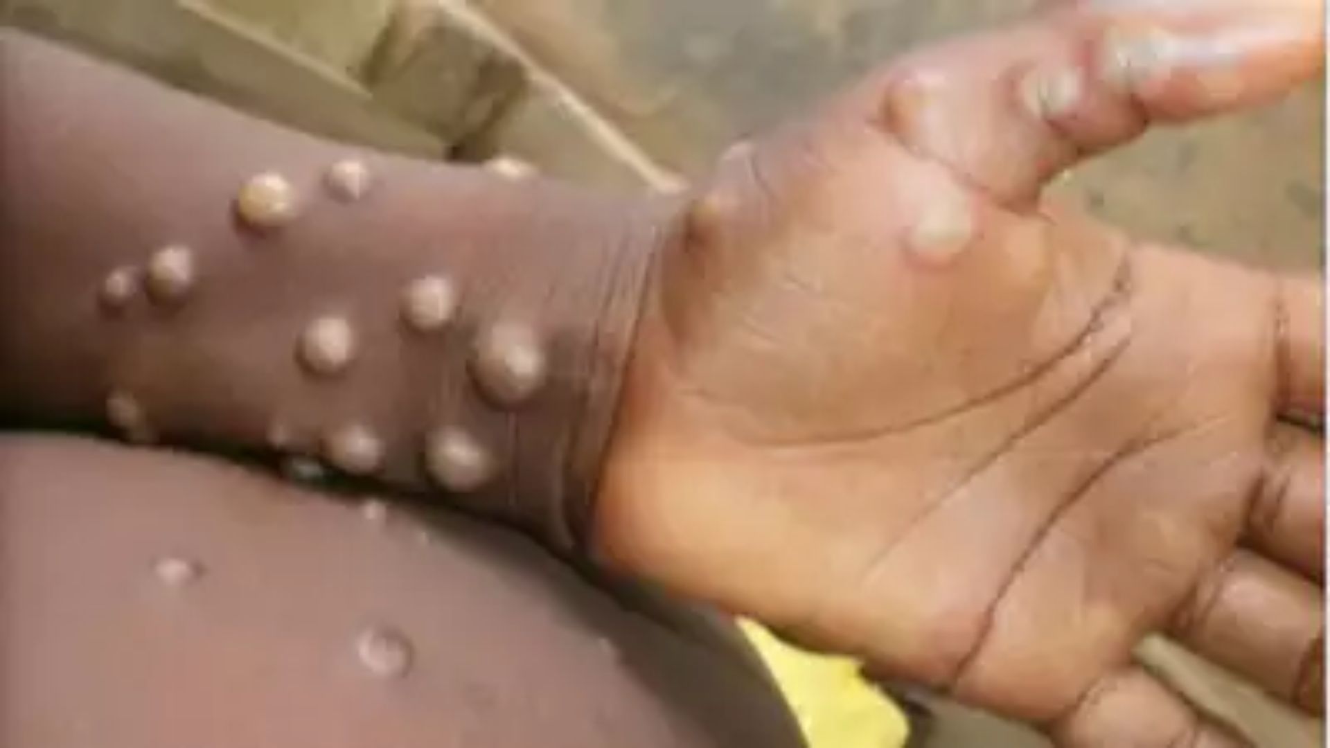 Central Government Heightens Vigil at Airports and Borders Amid Global Mpox Surge