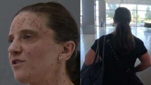 California Nurse Claims Discrimination After Being Banned From Southwest Airlines Flight For Skin Condition