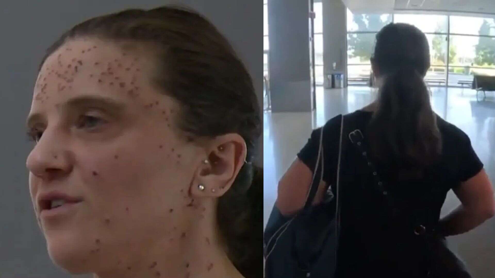 California Nurse Claims Discrimination After Being Banned From Southwest Airlines Flight For Skin Condition