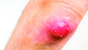 Carbuncles: A painful skin infection What is a Carbuncle?