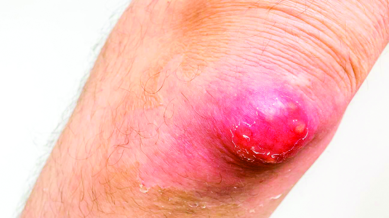 Carbuncles: A painful skin infection What is a Carbuncle?