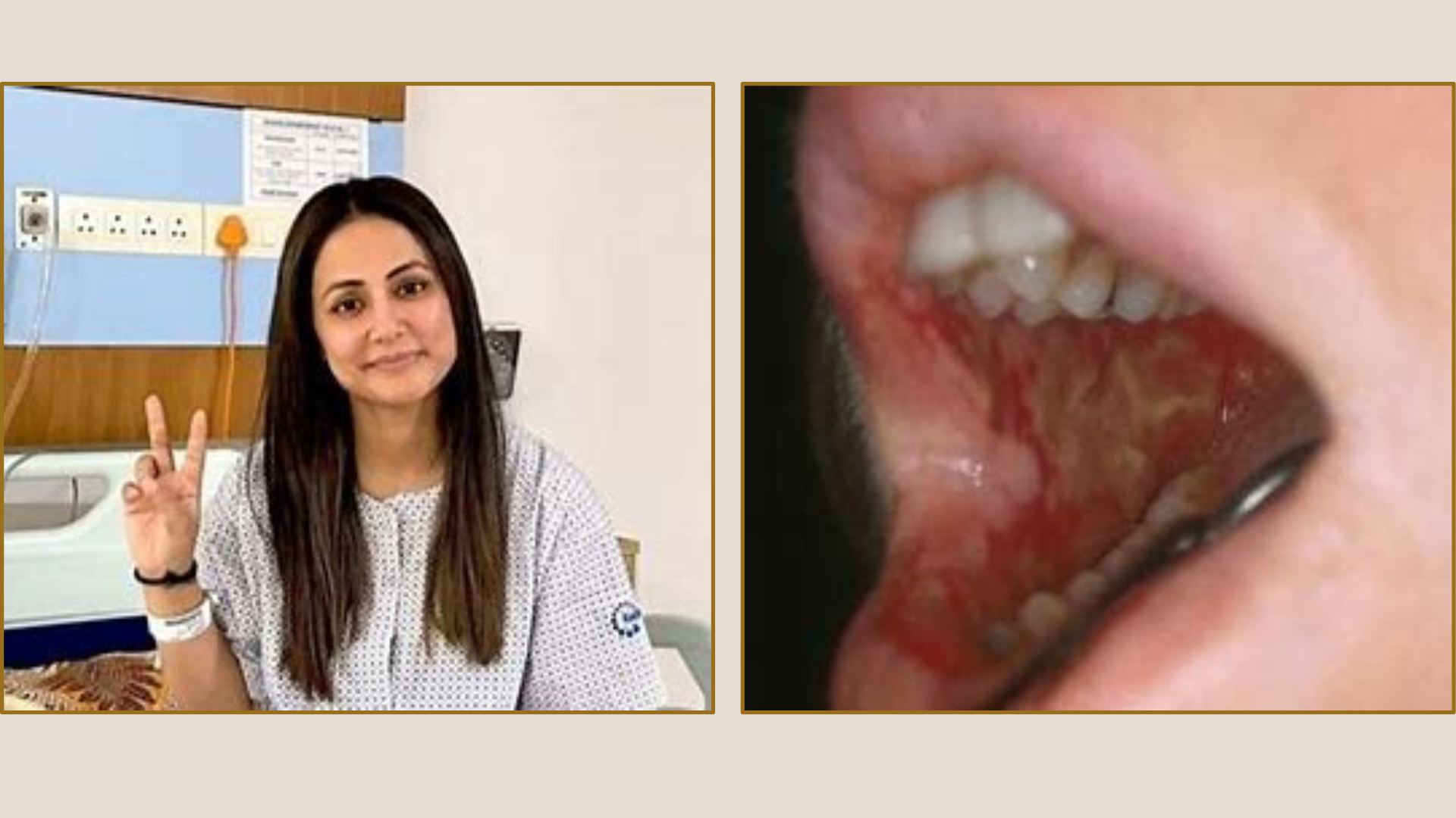 Hina Khan Battles Mucositis Amid Chemotherapy