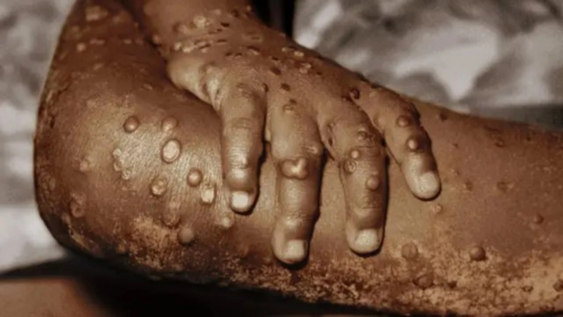 Monkeypox Confirmed in India: 26-Year-Old Haryana Man Tests Positive