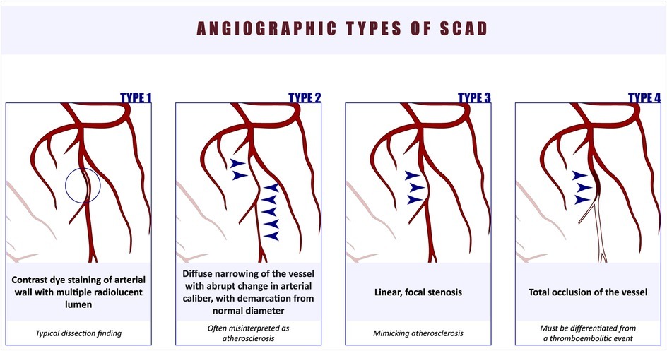 SCAD Explained – A Closer Look at Spontaneous Coronary Artery Dissection