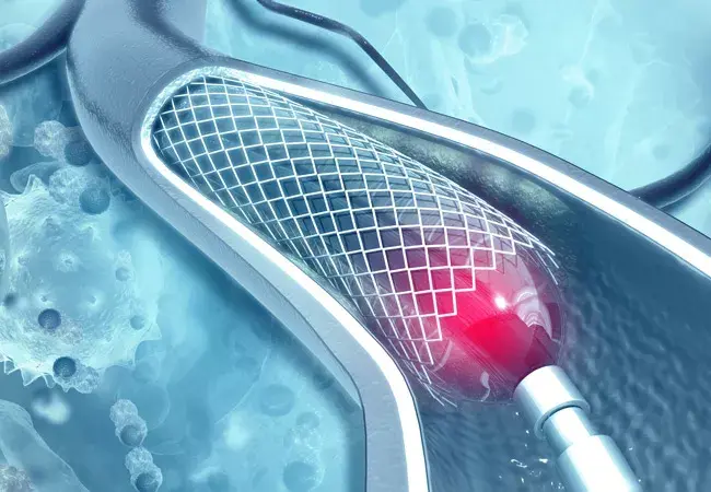 Laser-Enhanced Stents: A Revolutionary Step in Vascular Treatment