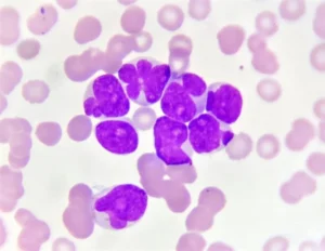 “New Triplet Therapies Show Promising Results for Relapsed and Newly Diagnosed Leukemia Patients”