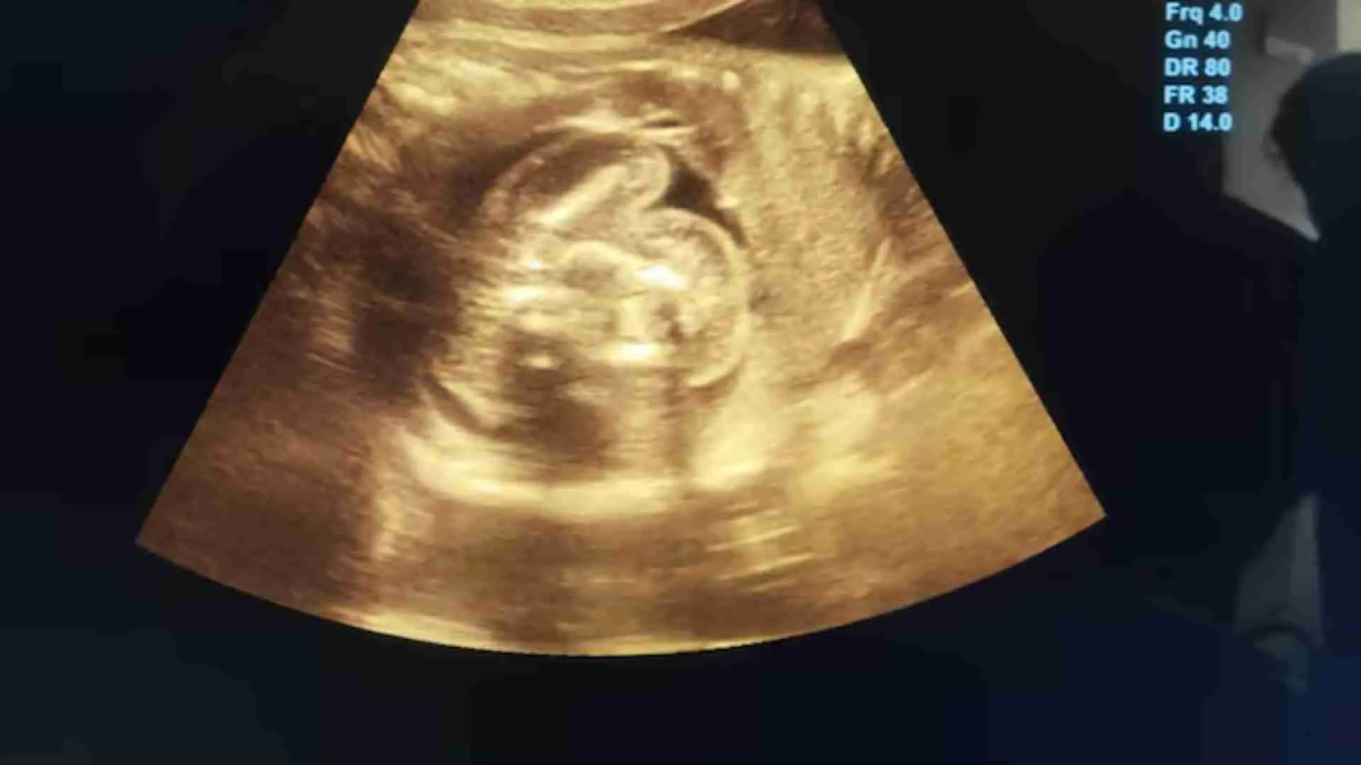 Rare ‘Foetus Inside Foetus’ Found Inside Pregnant Woman In Maharashtra