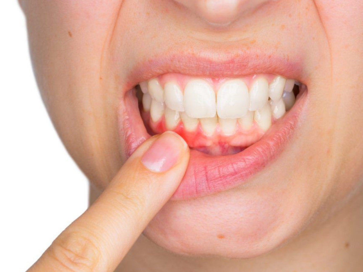 Bleeding gums may mean your body lacks Vitamin C. - Photo Gallery