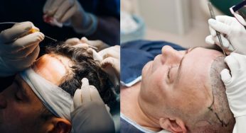 Cheaper Hair Transplant Turns Deadly: British Man Dies After 5-Hour Procedure in Turkey