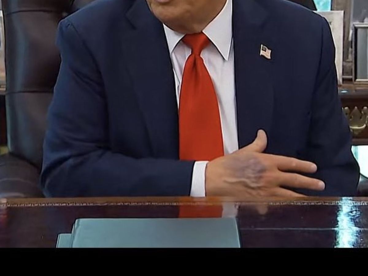 Donald Trumps hand bruise - Photo Gallery